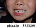歯が抜けた！