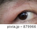 虫刺されのまぶた