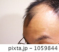 薄毛の悩みー4