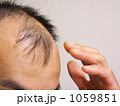 薄毛の悩みー５