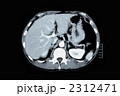 腹部CT
