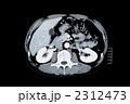 腹部CT