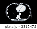 胸部CT