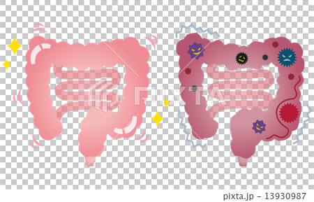 插图素材 结肠癌是健康结肠病