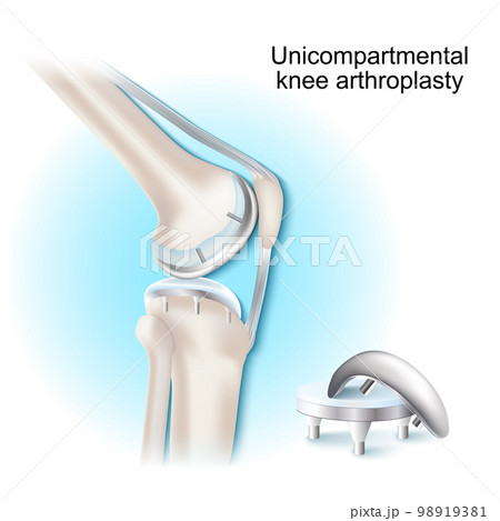 Unicompartmental knee arthroplasty surgical のイラスト素材 98919381 PIXTA