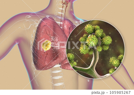 Lung mucormycosis lesion caused by のイラスト素材 105985267 PIXTA