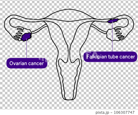 卵巣がんと卵管がんのシンプルなイラストのイラスト素材 106307747 PIXTA