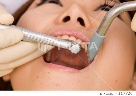 歯科治療イメージ 317726