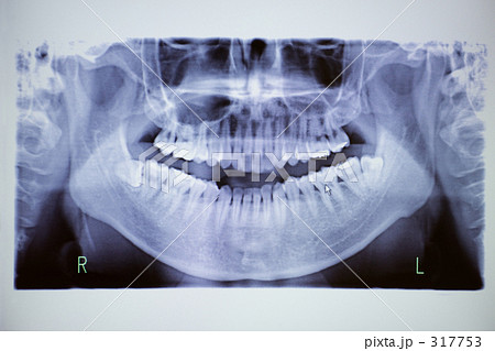 歯のレントゲン写真 317753