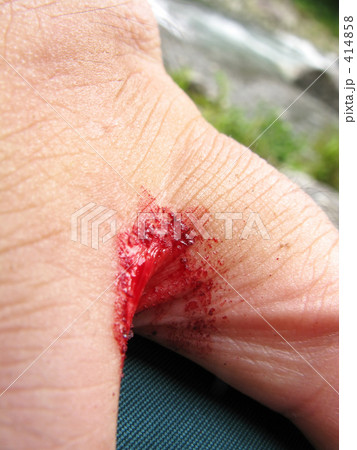 ヒルにやられた昼下がり 414858