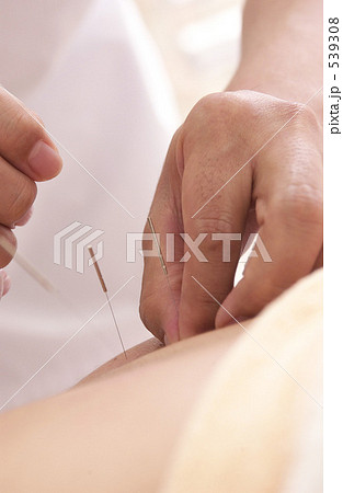 鍼灸 539308