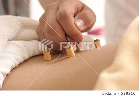 お灸 539310