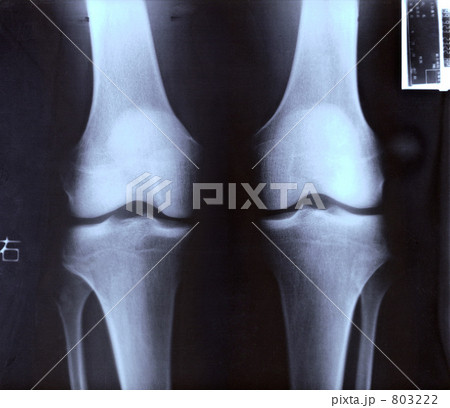 レントゲンで撮った膝の関節 後方から レントゲンで撮った膝の関節 後方から 803222