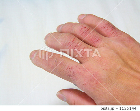 アカギレの手ー２ 1155144