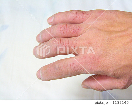 アカギレの手ー３ 1155146