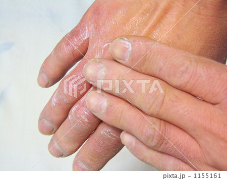手荒れ防止ー４ 1155161
