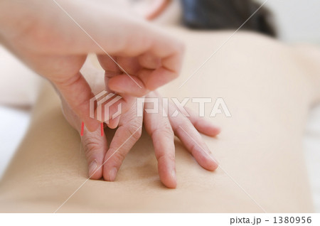 鍼治療 鍼治療 1380956