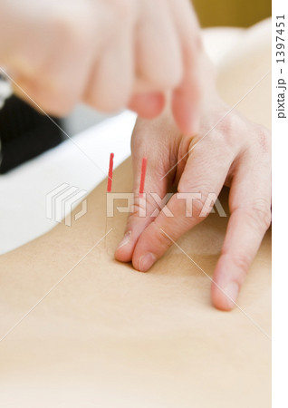 鍼治療 鍼治療 1397451