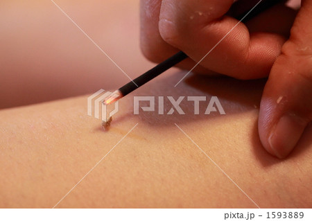 お灸 1593889