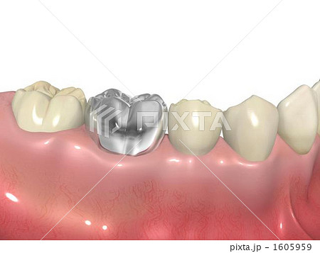 銀歯 銀歯 1605959