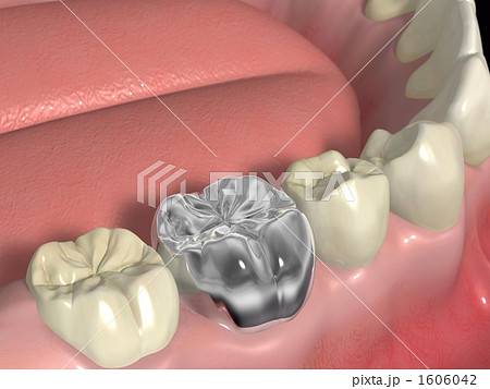 銀歯 銀歯 1606042