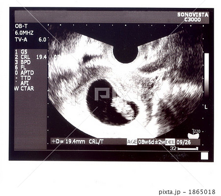 エコー写真 妊娠3カ月 エコー写真 妊娠3カ月 1865018