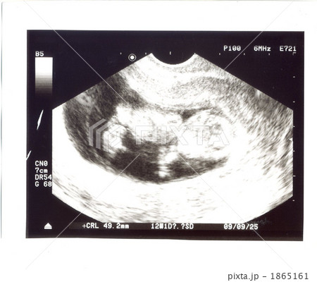 エコー写真　４カ月 1865161