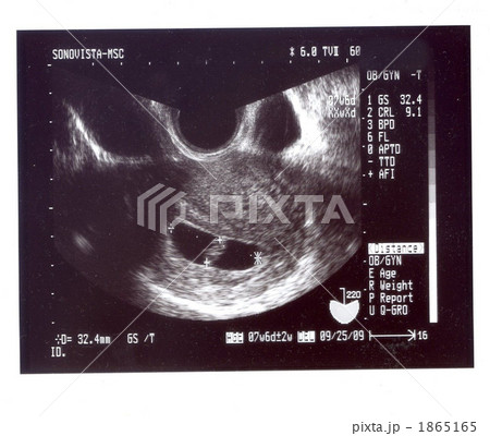 エコー写真 妊娠２カ月の写真素材