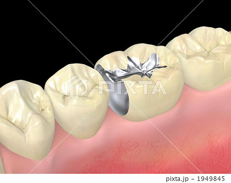 インレー 1949845