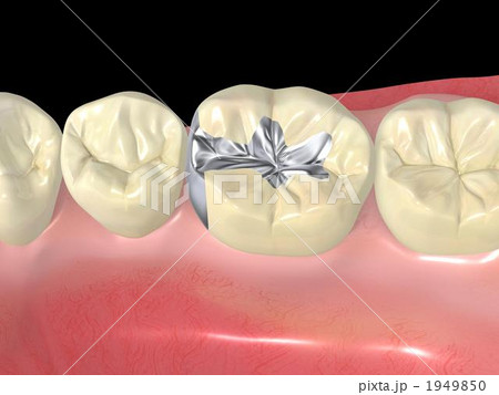 インレー 1949850