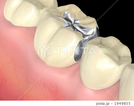 インレー インレー 1949855