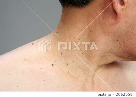 首のポツポツ 角質粒 の写真の写真素材