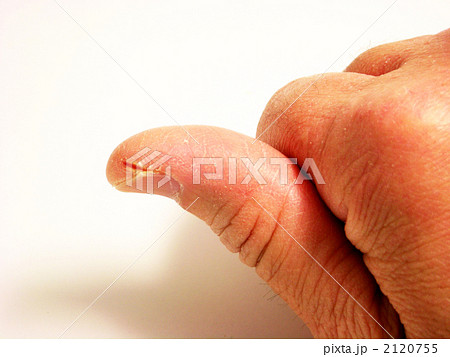 ひび割れた親指 2120755