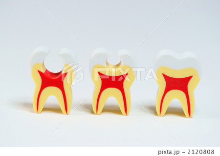 ムシ歯の進行度 2120808
