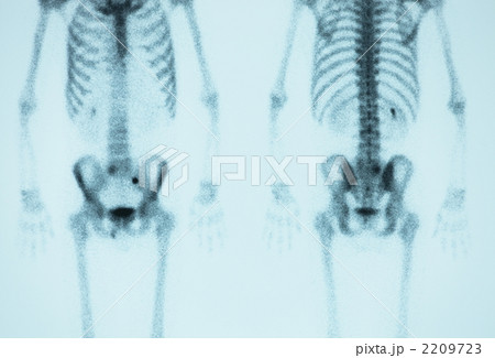 骨シンチグラフィー 2209723