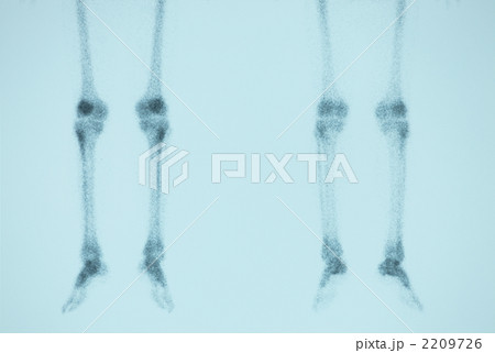 骨シンチグラフィー 2209726