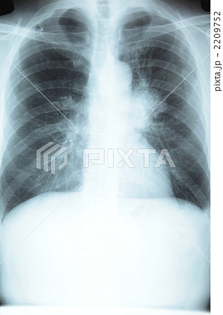 胸部レントゲン写真 2209752