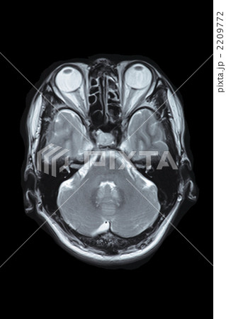 脳のMRI断層写真 脳のMRI断層写真 2209772