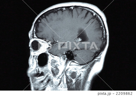 脳のMRI断層写真 脳のMRI断層写真 2209862