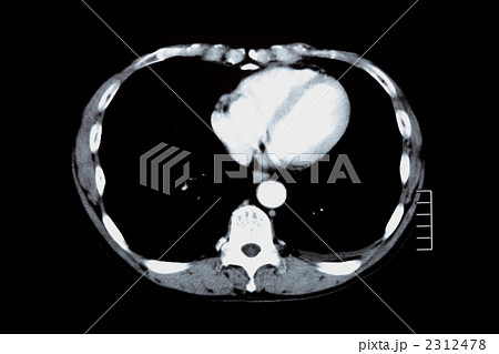 胸部CT 2312478
