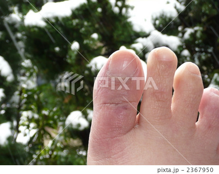 しもやけと雪 2367950