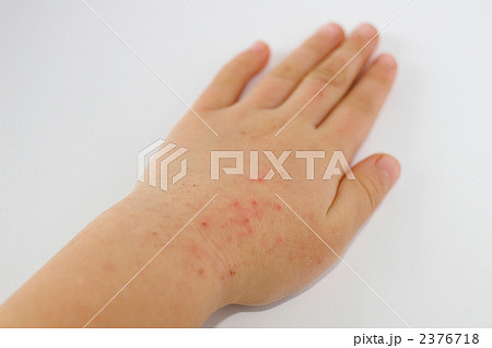 皮膚の炎症、左手 2376718