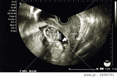 エコー写真(14週)の写真素材 [2699791] - PIXTA