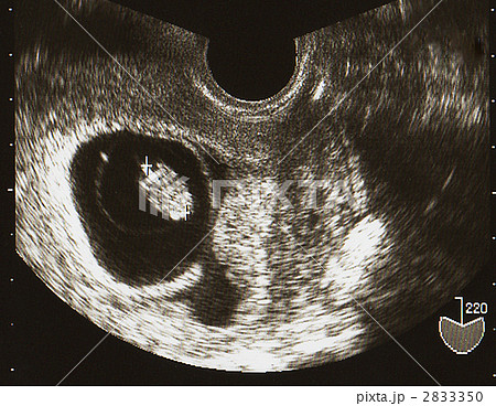 エコー写真 胎児 ７週の写真素材