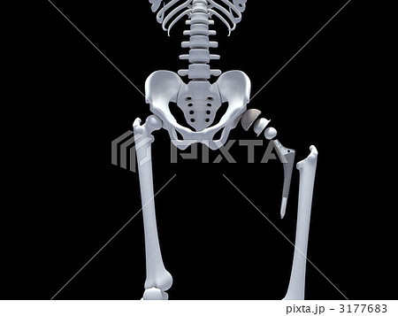 人工関節 3177683