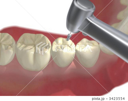 歯科治療 歯科治療 3423554