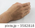 手荒れ 3582818