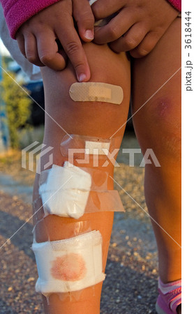 Child showing her leg wounds Child showing her leg wounds 3618444