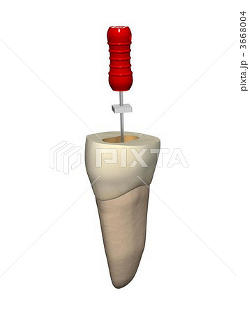 根管治療 3668004