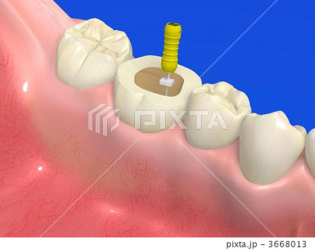 根管治療 根管治療 3668013